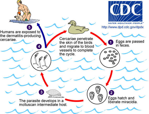 Swimmer's itch - CDC